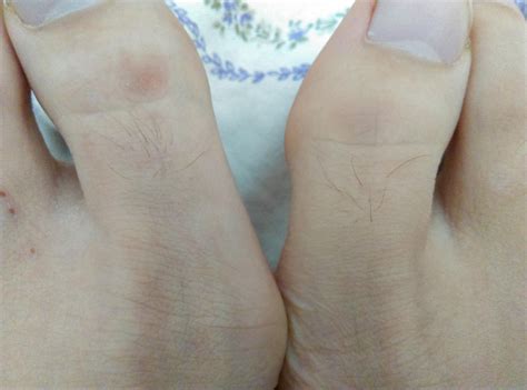hair growing on thumb 2