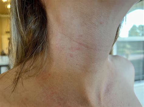 Super itchy neck and chest : r/DermatologyQuestions