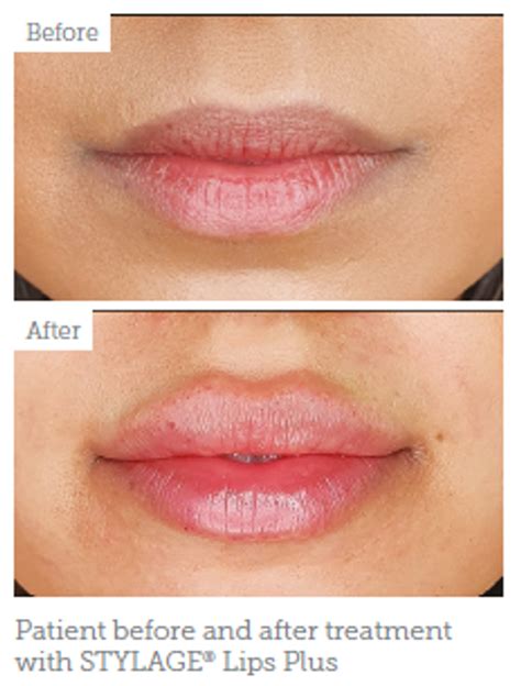 Advertorial: New Lip Filler Stylage Lips Plus - Aesthetics