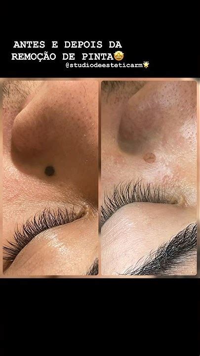 Remoção De Pintas Antes E Depois - Antes e depois da remoção de pinta! 🤩 - YouTube