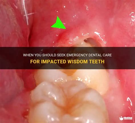 When You Should Seek Emergency Dental Care For Impacted Wisdom Teeth ...