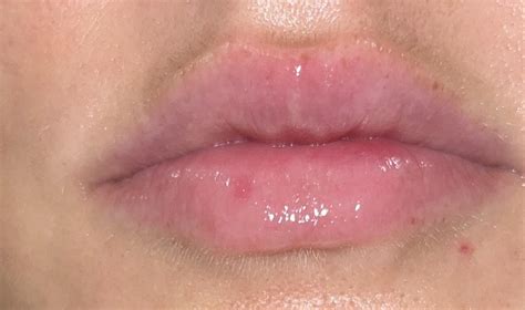 Cold sore? : r/Coldsore