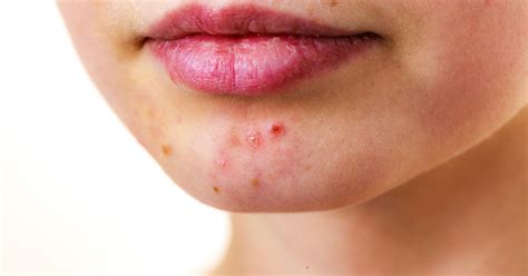 PCOS and Skin Conditions: Effective Treatment Strategies - PCOS ...
