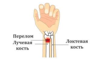 Перелом лучевой кости: симптомы, сроки лечение, первая помощь