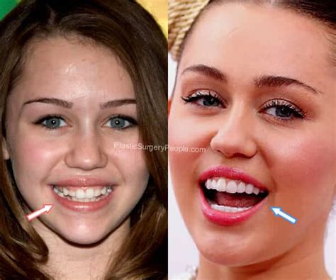 Miley Cyrus, BEFORE and AFTER 2022