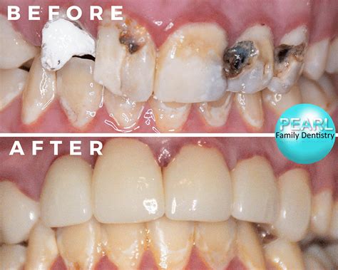 Before & After Dental Crowns | Dentist in Merced, CA