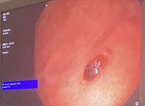 endoscopic image showing  dieulafoy lesion  scientific