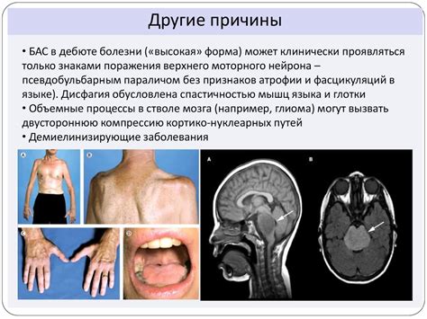 Псевдобульбарный паралич - презентация онлайн