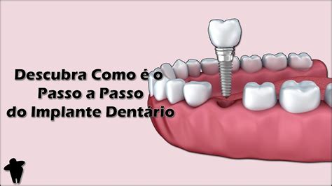 Implante Dentário Passo A Passo - Descubra Como é Feito Um Implante Dentário - Passo a Passo - Fases ...