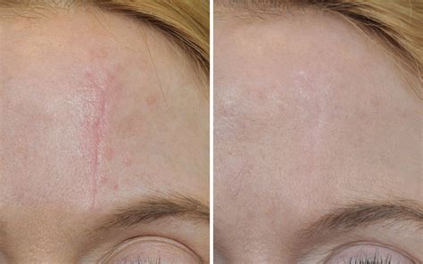 Laser Scar Therapy Before And After