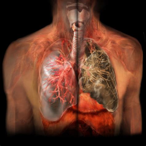 smokers lungs  smoking