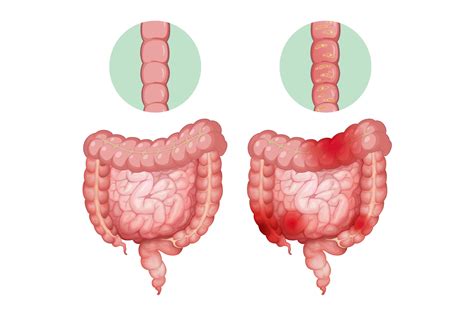 Colitis – Liv Gastro