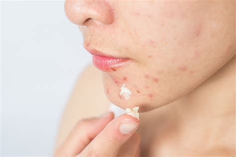 What Is Sulfur and Why Is It So Good for Your Skin | Allure