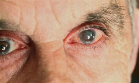 What are the symptoms of diabetic macular edema? - FITPAA