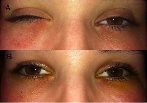 drug induced periorbital edema drug induced oedema treatment pbff