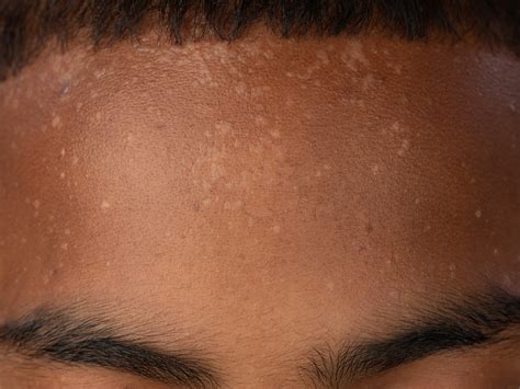 Epidermodysplasia Verruciformis Voor En Na Epidermodysplasia