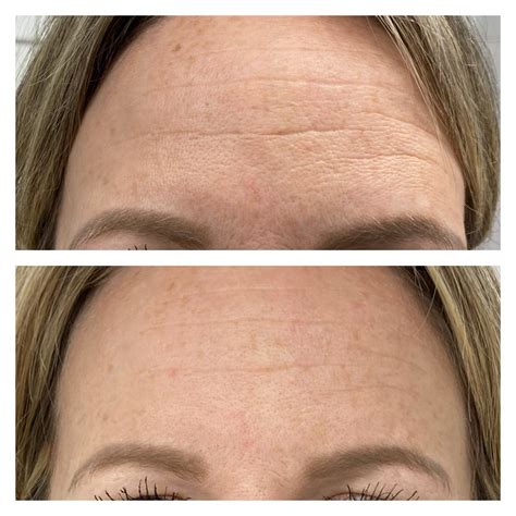 Microneedling Before and After Results - Nikki Butler: Skin Specialist