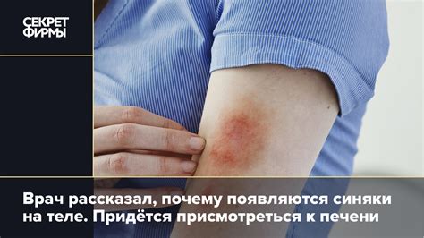 Врач рассказал, почему появляются синяки на теле. Придётся ...