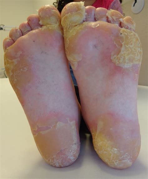 TRPV3-pEDD (palmoplantar Epidermal Differentiation Disorder)