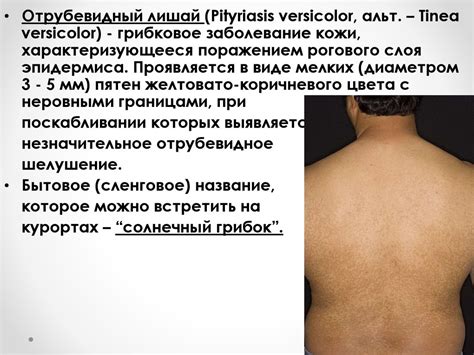 Отрубевидный лишай - презентация онлайн