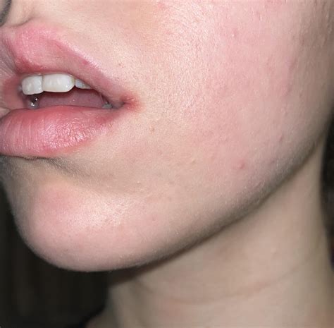 Does this look like PD? : r/Perioral_Dermatitis_
