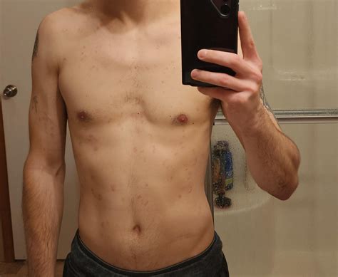 Guatte psoriasis is it Severe? : r/Psoriasis