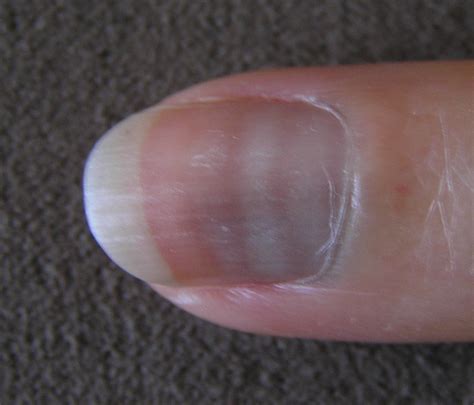 Nail Fungus Case Studies | GNFO