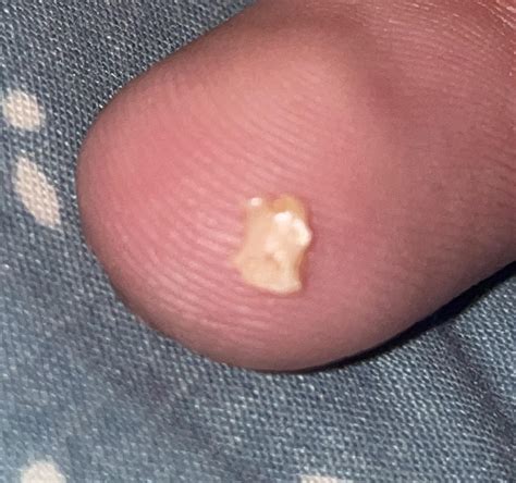 gum bone spur treatment  andy sage blog