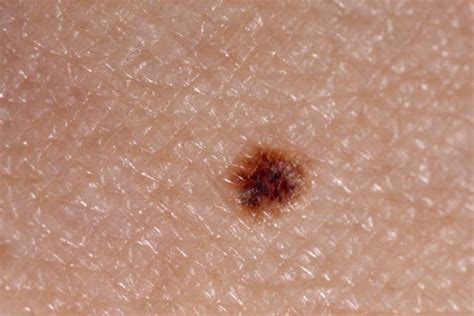 110+ Mole Melanoma Freckle Women Stock Photos, Pictures & Royalty-Free Images - iStock