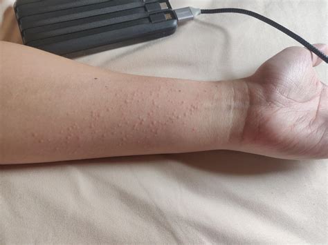Woke up to this random itchy rash, never before : r/Dermatology