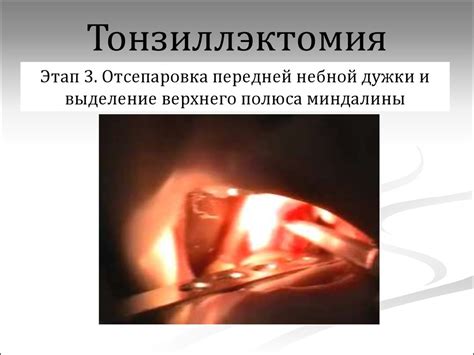 Хронический фарингит - презентация онлайн