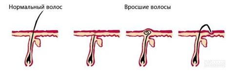 Как избавиться от вросших волос – TOP BARBERSHOP