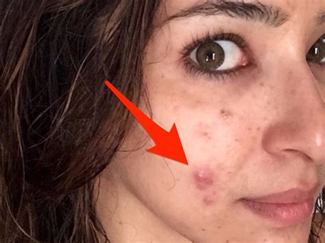 What Is Cystic Acne? : Beauty Care & Medical Devices
