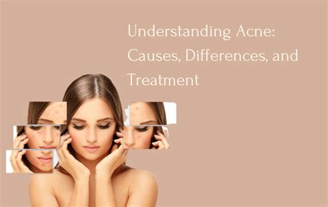 Understanding Acne: Causes, Differences from Pimples, and Treatment ...