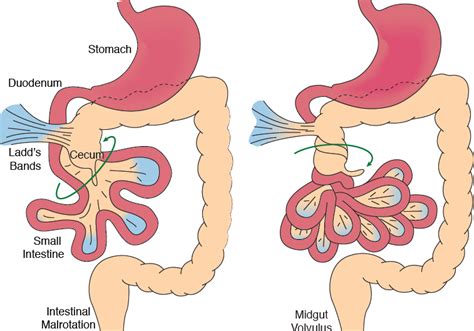 volvulus midgut malrotations