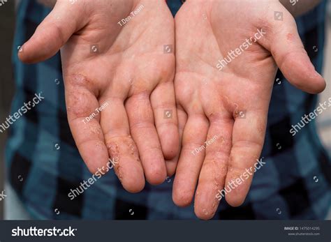 Dyshidrotic Eczema Hands Patient Concept Health Stock Photo (Edit Now ...
