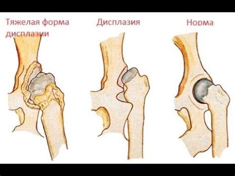 Дисплазия соединительной ткани. Лечение остеопатией. Вопросы и ответы ...