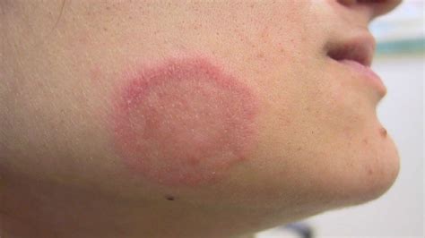 Tinea faciei causes, prevention, symptoms, diagnosis & treatment