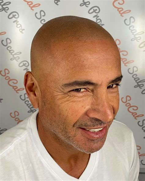 Scalpmora Gallery | Scalp Micropigmentation Transformations in Vista