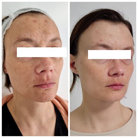 Laser blood vessel and discoloration removal