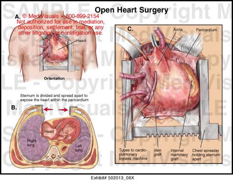 Medivisuals Open Heart Surgery Medical Illustration