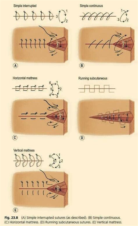 Suture Chart Suture Types Surgical Suture Sutures | Images and Photos finder