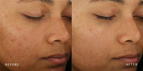diamond glow dallas tx diamond glow facial fort worth