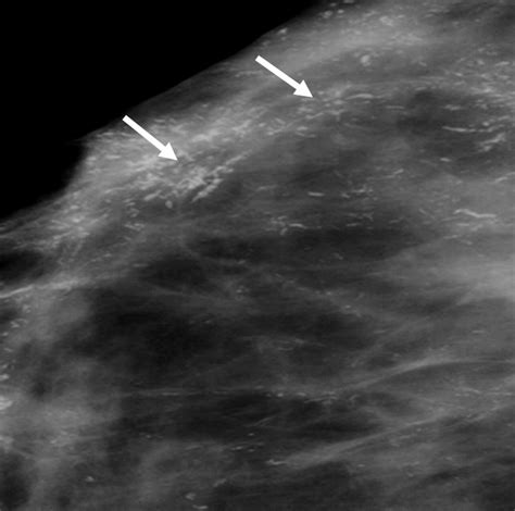 common  unusual diseases   nipple areolar complex radiographics