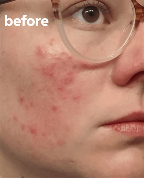 Ivermectin success!! So far: : r/Rosacea