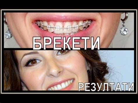Живот с брекети 1 част - YouTube