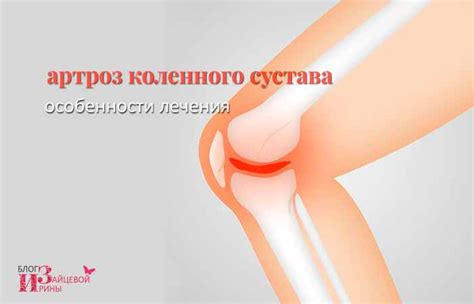 Артроз коленного сустава (гонартроз). Симптомы, причины и лечение
