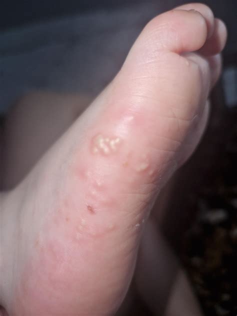 Is this scabies ? Just on my sons feet? : r/scabies