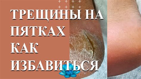 Трещины на пятках, как избавиться. Рефлексология стоп. - YouTube