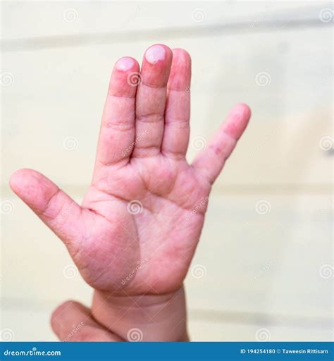 The Blister on Children Finger Caused by Hot Water Injury Stock Photo